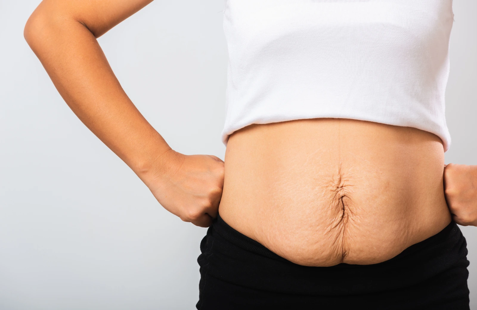 Stretch mark treatment in Hyderabad