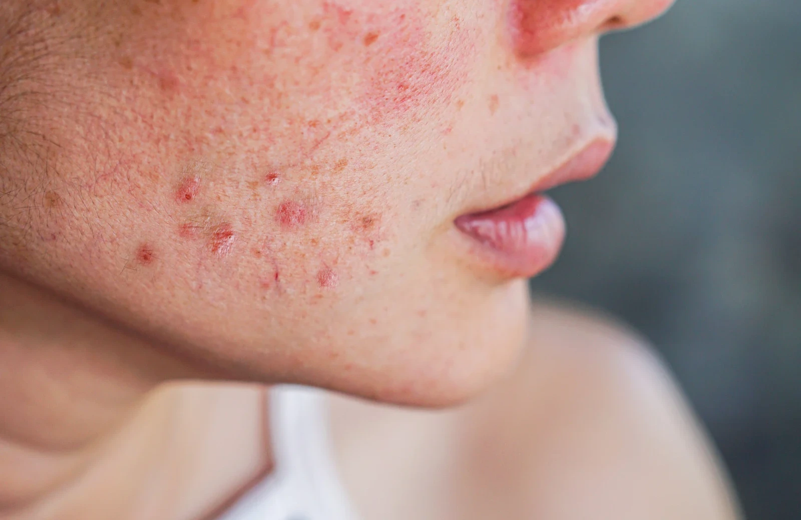 Acne Scar Treatment in Hyderabad