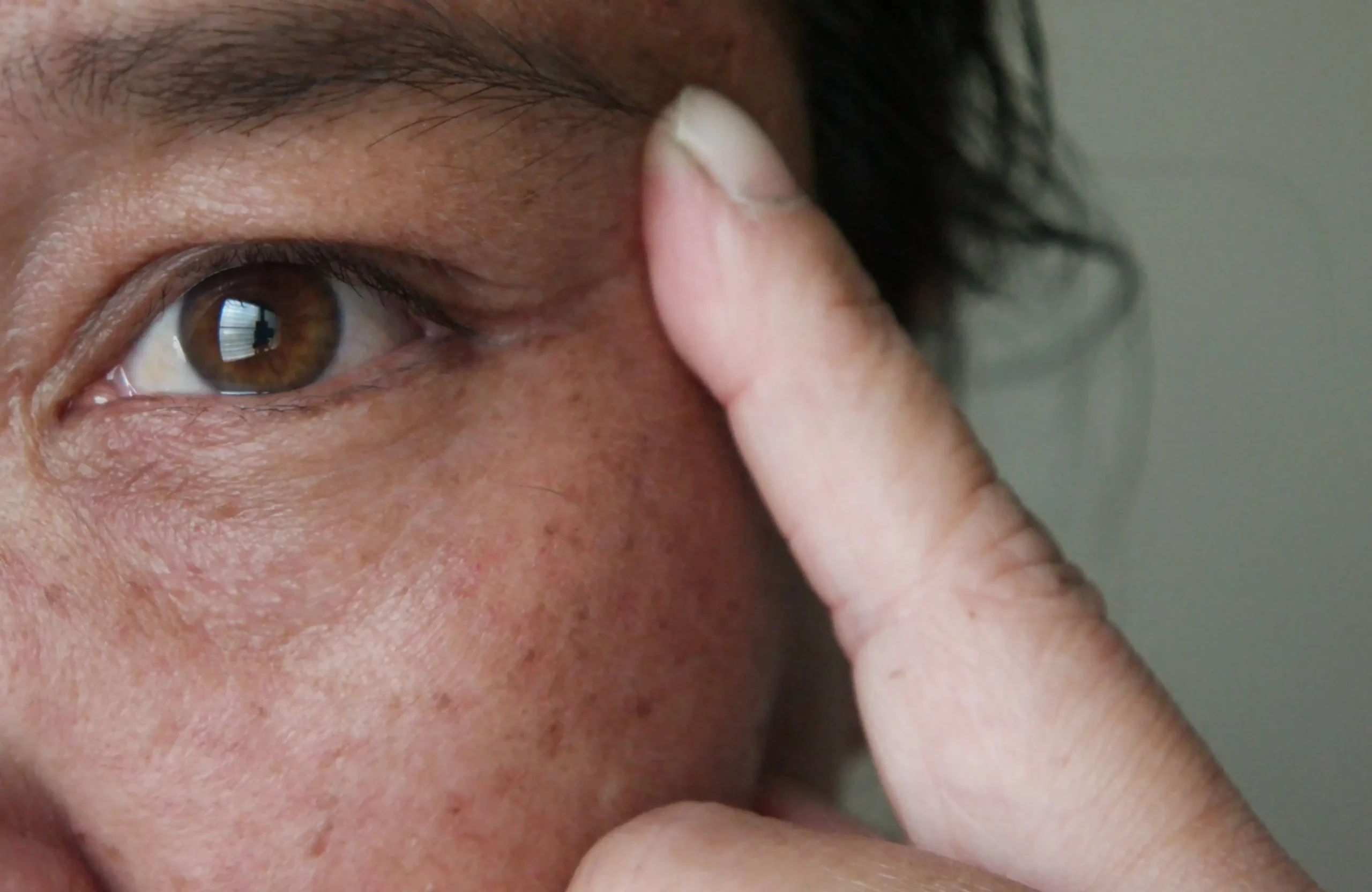 Pigmentation Treatment in Hyderabad