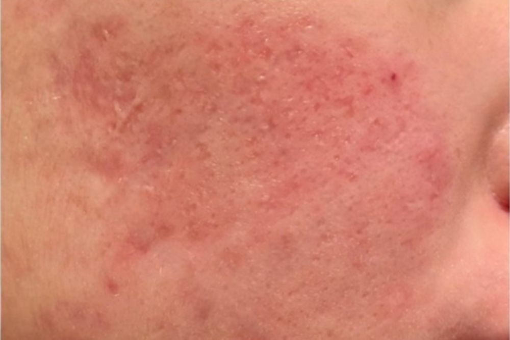 Acne-After-Zennara