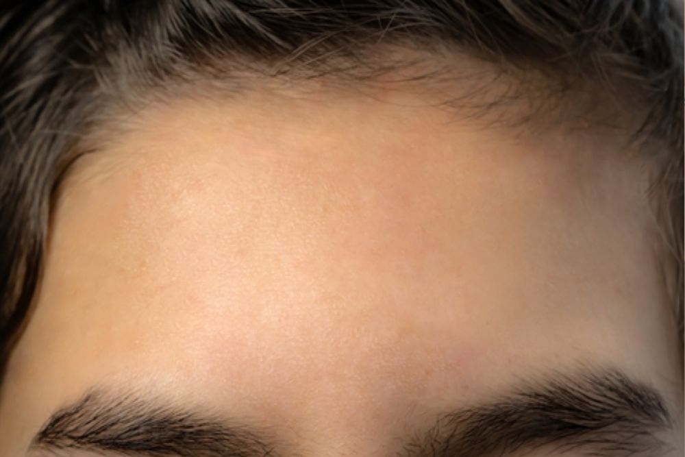 Acne-Clearance-After-Zennara