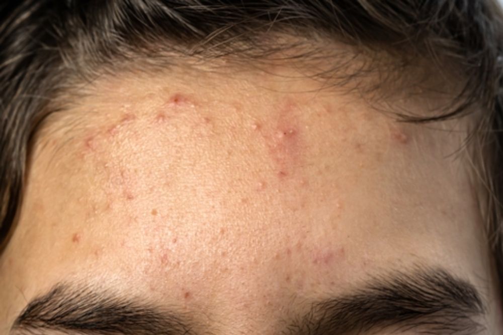 Acne-Clearance-Before-Zennara