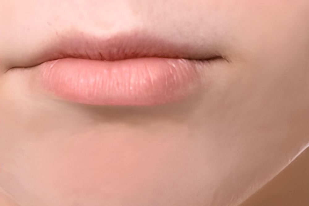 Acne-Scars-After-Zennara