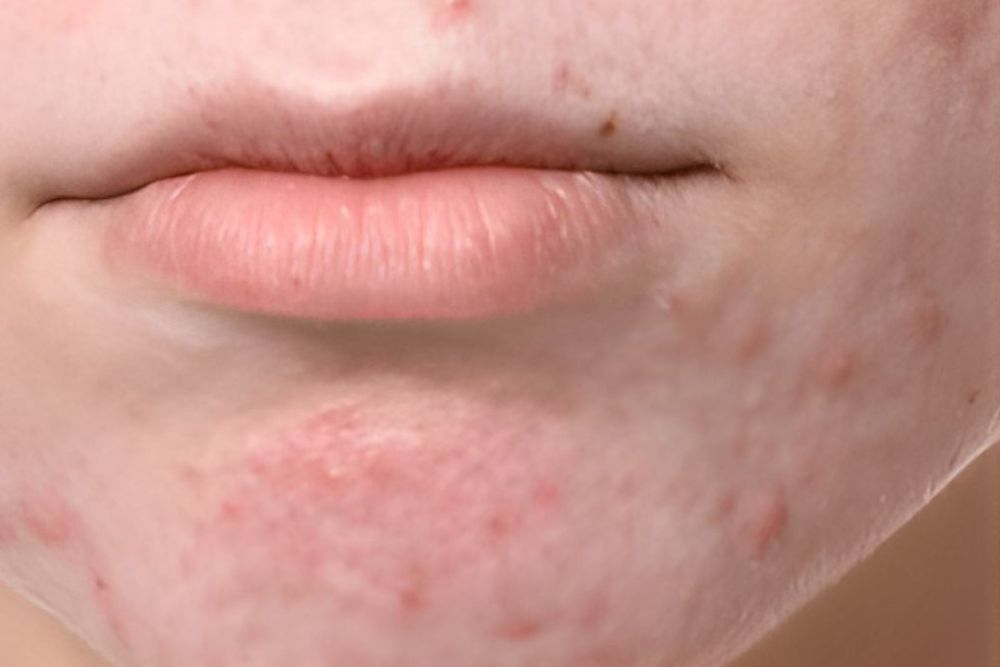 Acne-Scars-Before-Zennara