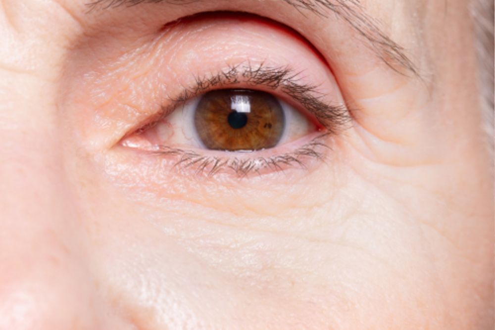 Dermal-Filler-Treatment-After-Zennara