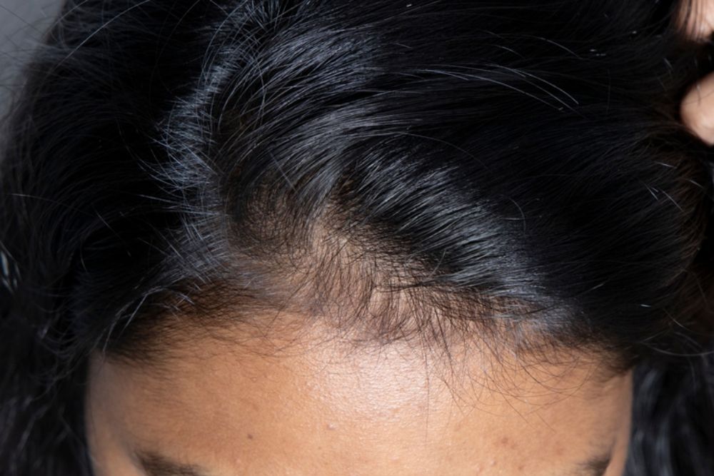 Hair-Treatment-Before-Zennara