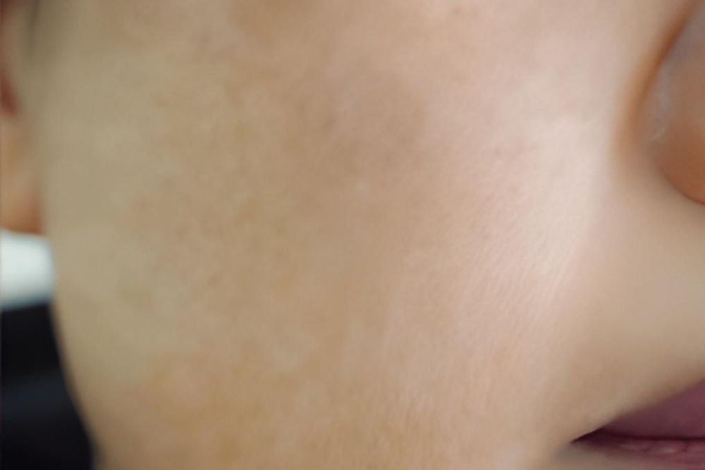 Melasma-After-Zennara