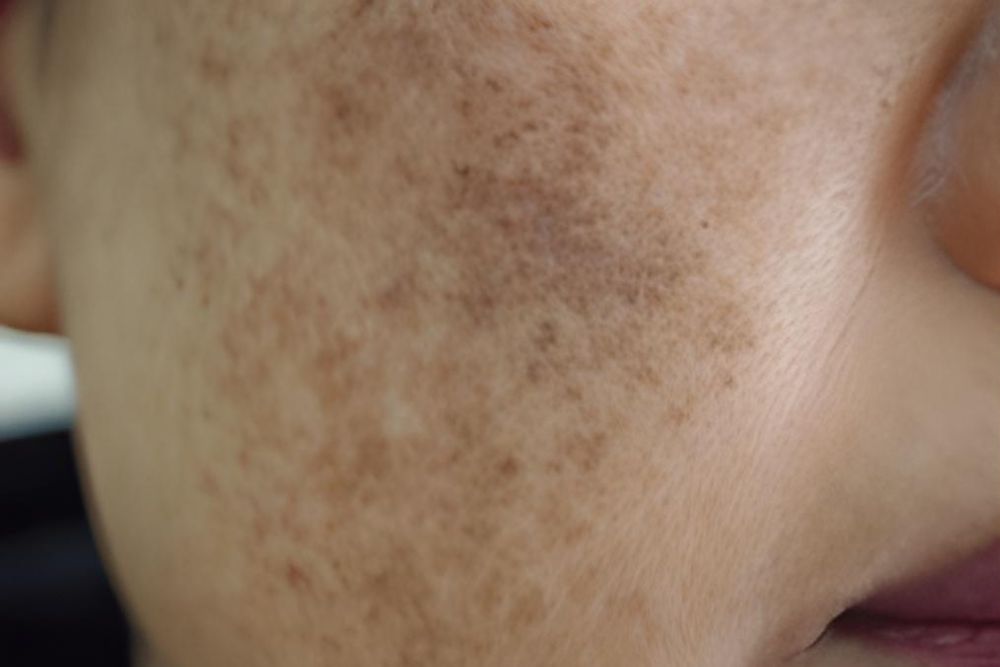 Melasma-Before-Zennara