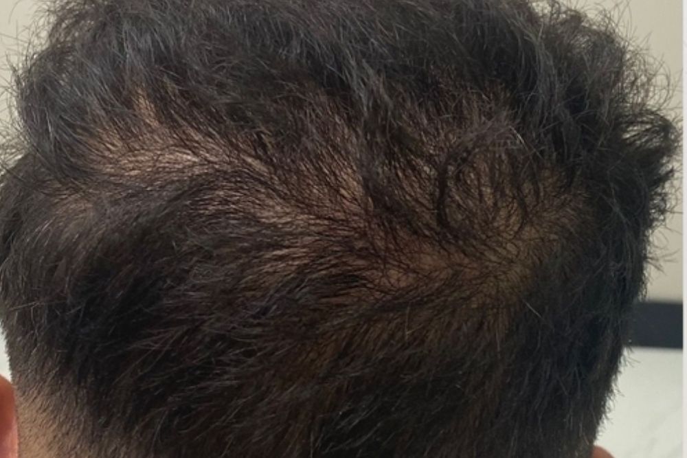 PRP-Hair-Therapy-Before-Zennara