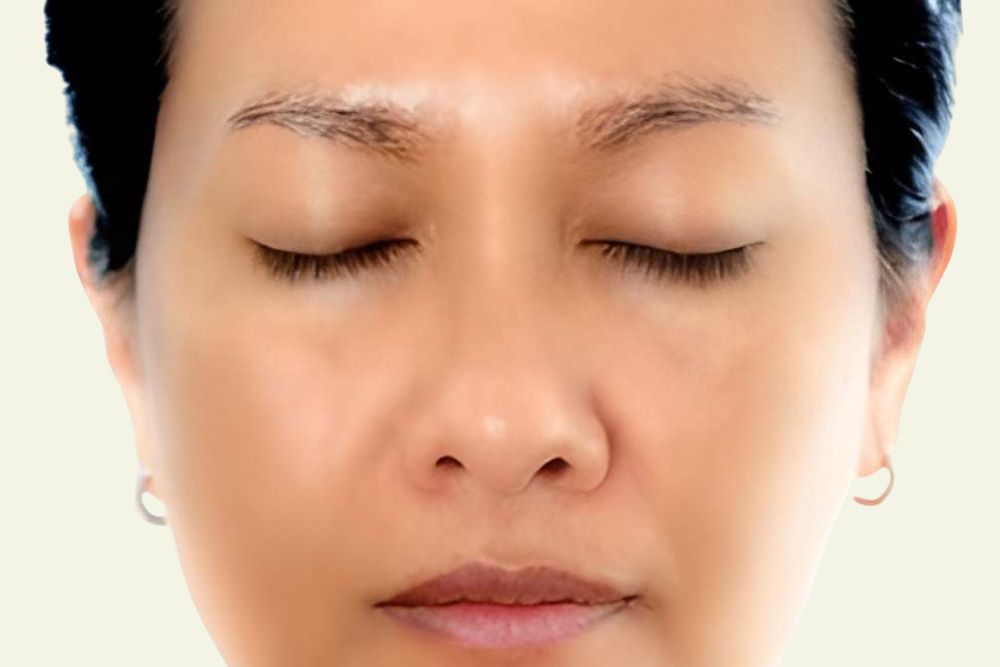 Pigmentation-After-Zennara