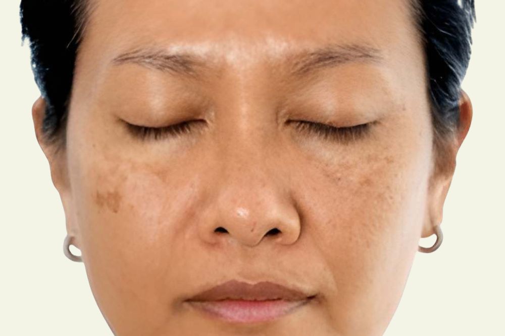 Pigmentation-Before-Zennara