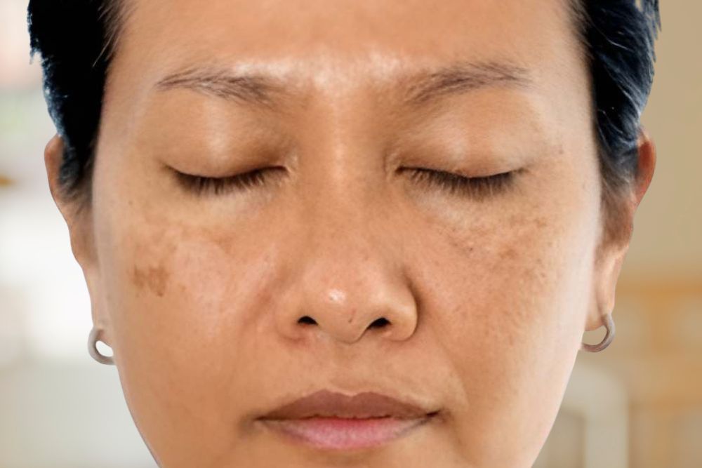 Pigmentation-Before-Zennara