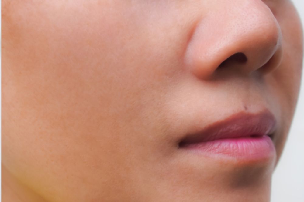 Pigmentation-Correction-After-Zennara