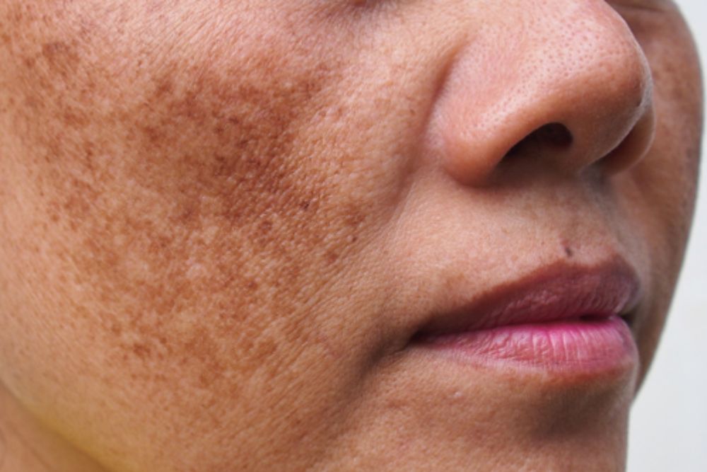 Pigmentation-Correction-Before-Zennara