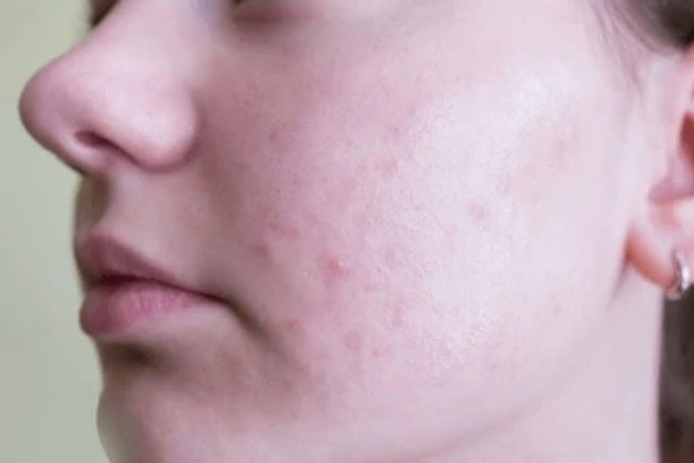 Pigmentation-Facial-Before-Zennara