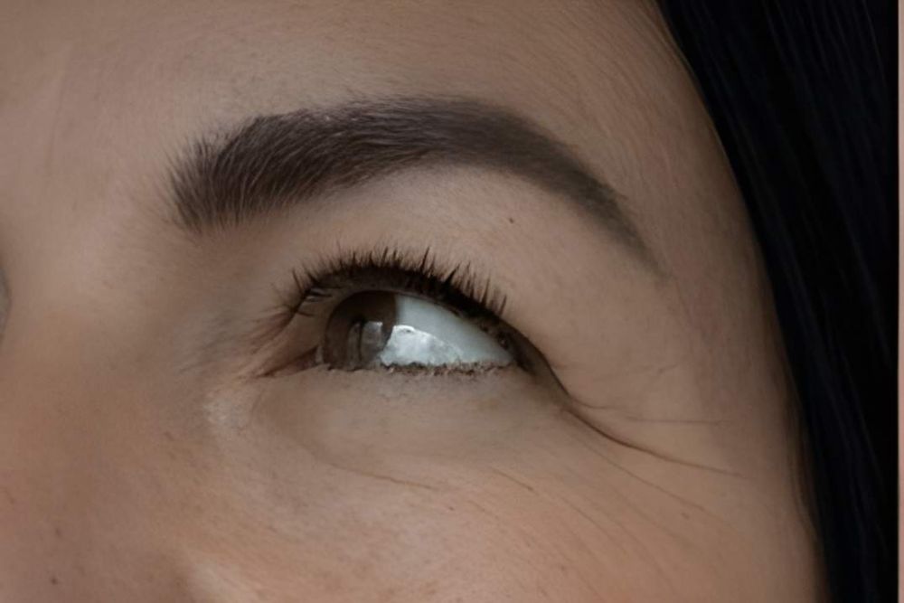 Skin-Rejuvenation-Before-Zennara