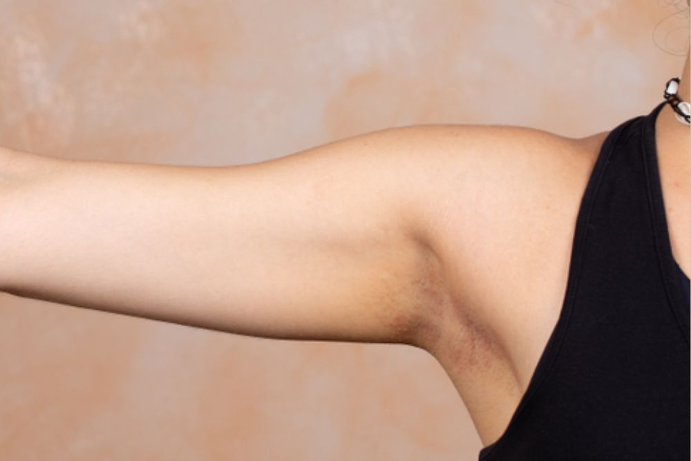 Skin-Tightening-Treatment-After-Zennara