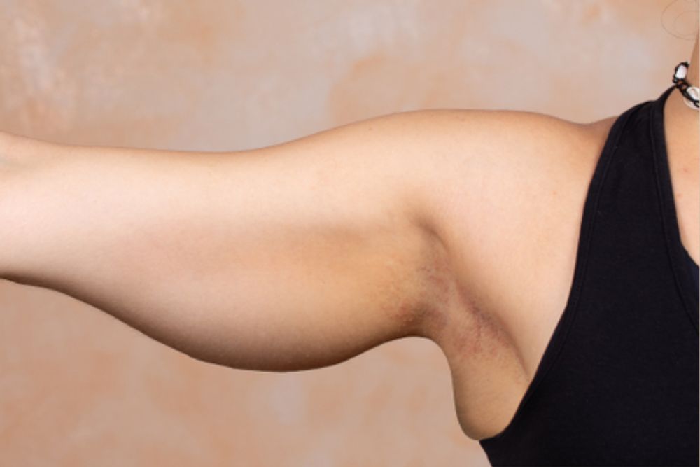 Skin-Tightening-Treatment-Before-Zennara