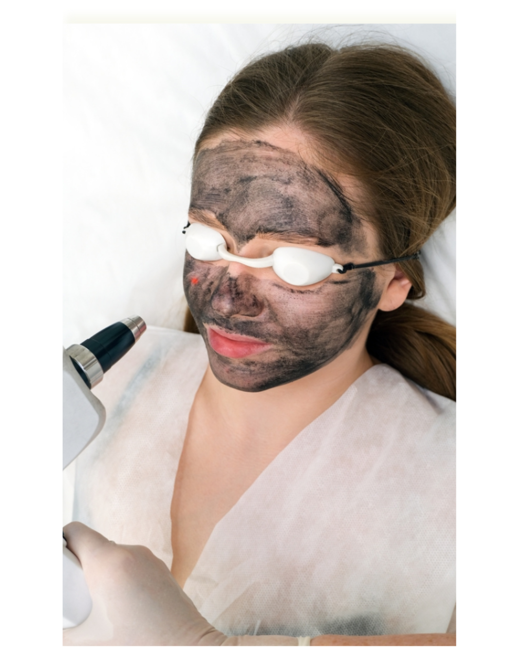 Carbon-Laser-Treatment-Zennara