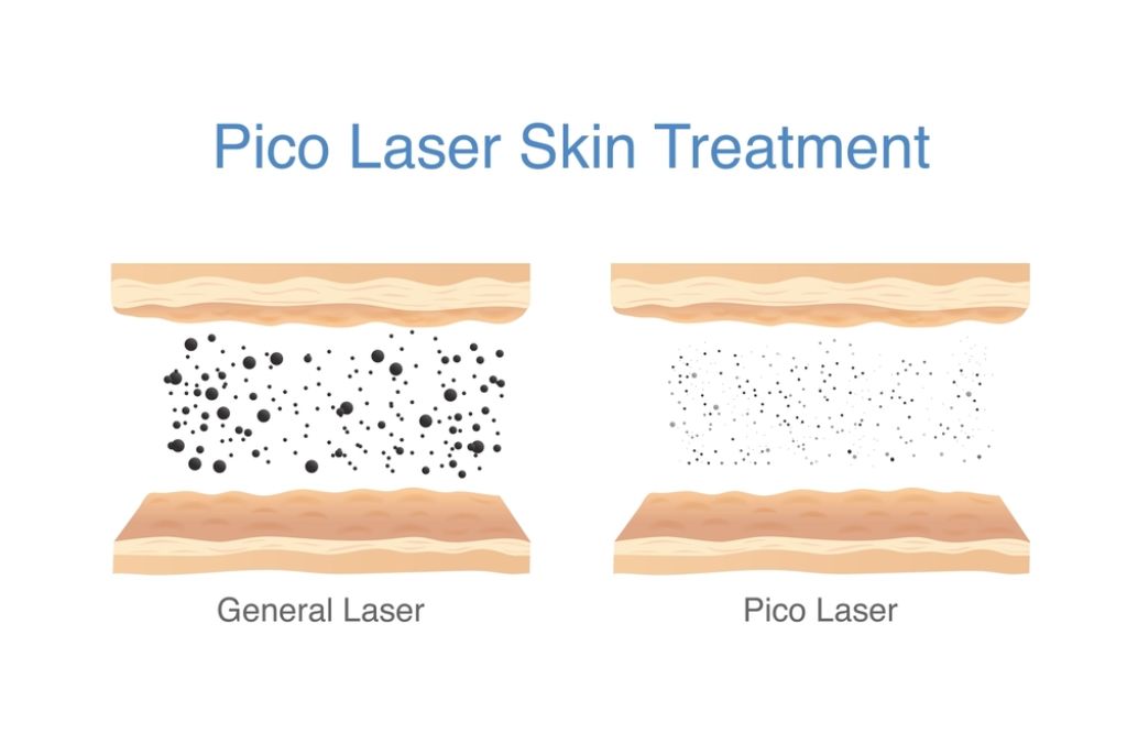 What_Is_Pico_Laser_and_How_Is_It_Different_Zennara