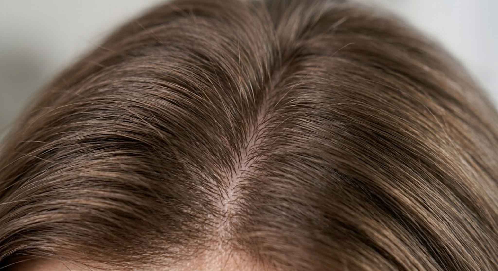 GFC_hair_treatment_for_hair_regrowth_Zennara_Clinic_Hyderabad